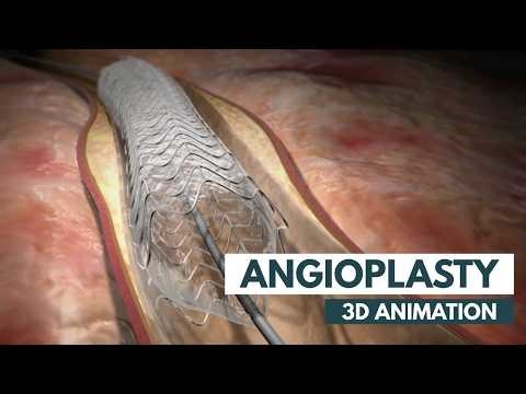 3D Angioplasty Animation | Coronary Artery Blockage, Balloon Stent & Heart Blood Flow Restoration