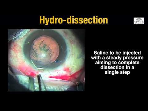 Episode 3 : Hydro-procedures in MSICS