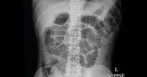 Look: This dime-sized robot wants to burrow into your stomach for science