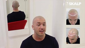 4.1K views · 10 comments | Skalp offers several different types of Scalp Micropigmentation (medical hairline tattoo), depending upon the hair style and extent of hair loss. | Skalp | Facebook