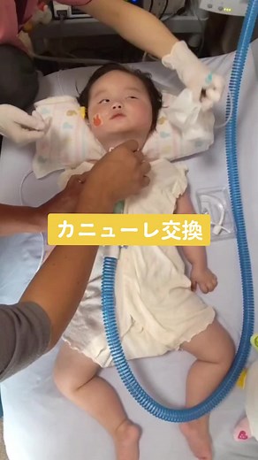 気切とカニューレ交換の生活サポート