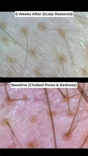 Fix Your Scalp First. Then Focus on DHT.
