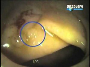 Colonoscopia, Cancer al Colon, Polipos ,Procedimiento