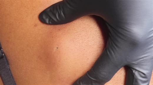 I Know It’s Been Awhile….. But This Should Make Up I will be back traveling as of March Dates for the following states will be posted: Los Angeles, Ca New York Houston,Tx New Orleans,La #skintok #facial #cystremoval #Extractions #skin