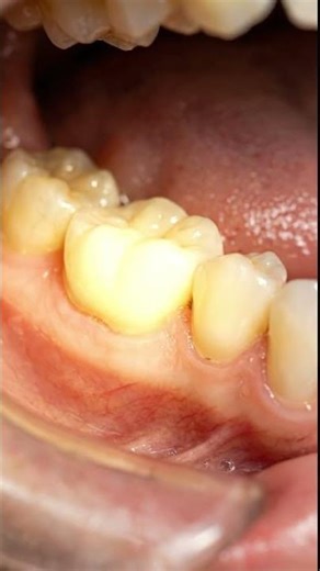Satisfying Restoration of a Broken Molar step-by-step procedure #dentist #satisfying #asmr