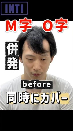 【M字 O字 薄毛カバー メンズ髪型】「M字も気になるしつむじも透ける…」そんなお悩みを同時にカバーしたスタイルです#薄毛札幌#AGA札幌#札幌美容室#薄毛男性専門美容室#INTI札幌#shorts