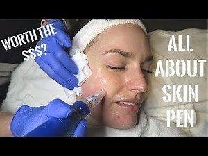 My First Skin Pen Treatment! Worth It?