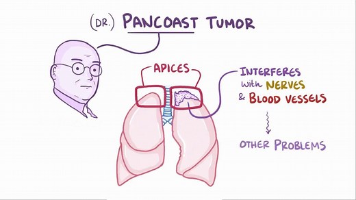 Video: Pancoast tumor - Video Explanation! | Osmosis | Osmosis
