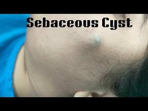 Sebaceous Cyst excision surgery | Surgery of sebaceous Cyst in Ranchi | scarless cyst surgery