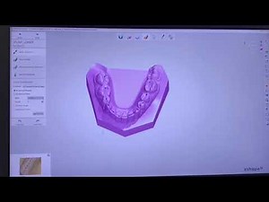 3Shape Aufbissschiene