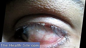 Blepharitis: Penyebab, Diagnosis & Lainnya 💊 Ilmiah-Praktis Medical Journal - 2025