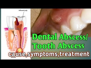 Dental Abscess: Cause, Symptoms, Treatment & Prevention | Periapical abscess | Periodontal abscess