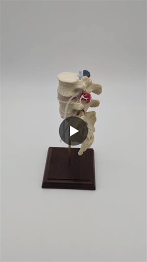 Dynamic Spine Model: Insights into Disc Pathology and Neurodynamics | Dynamic Disc Designs - CORPORATION posted on the topic | LinkedIn