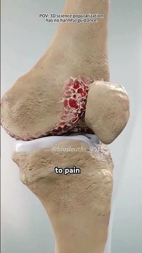 Visco Gel Injection For Treatment of Knee Osteoarthritis (3D Animation)