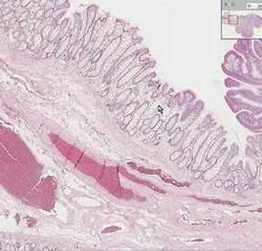 Histopathology Colon--Tubular adenoma (adenomatous polyp)