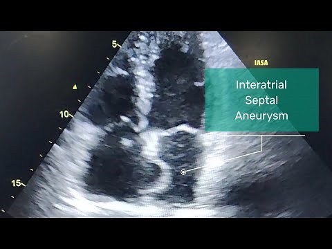Atrial septal aneurysm l Echo of atrial septal aneurysm