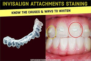 Invisalign Attachments Staining: How To Whiten And Clean - Orthodontic Braces Care