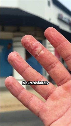 I Accidentally Burned Myself