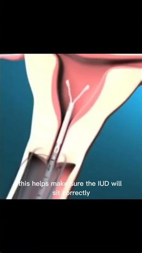 IUD Insertion Explained in 60 Seconds 😳 What REALLY Happens #IUD#BirthControl#WomensHealth