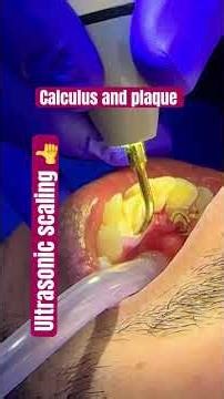 Scaling and polishing done. #scaling #teeth#shorts#short #shortvideo #calculus #teethcleaning