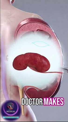 How Doctors Remove Large Kidney Stones