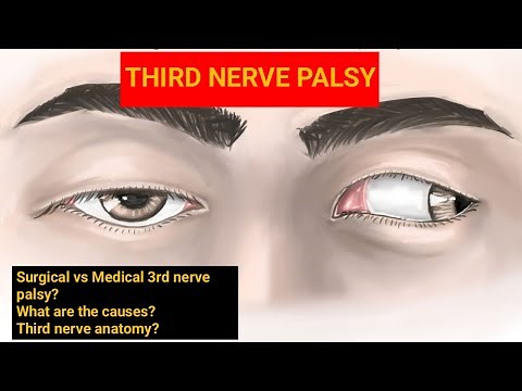 third nerve palsy | surgical vs medical third nerve palsy