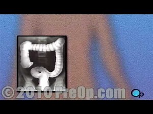 Endoscopy of Large Intestine Diagnostic Surgery PreOp® Patient Education Feature