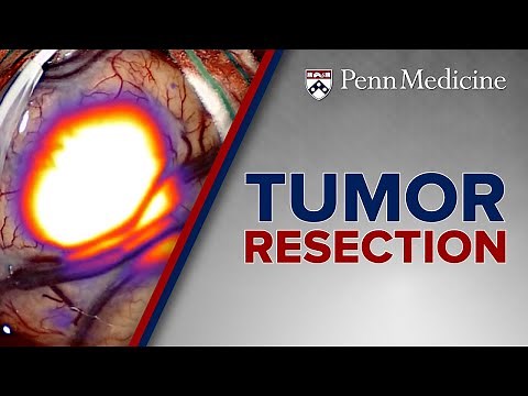 Head and Neck Tumor Resection at Penn Medicine