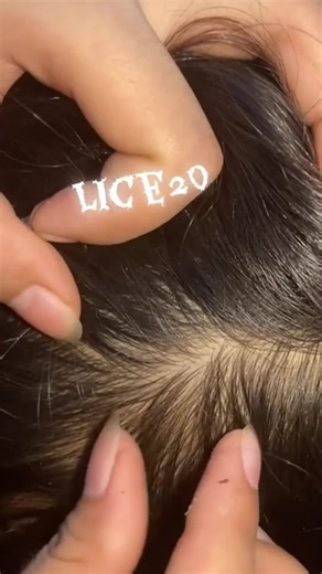 Effective Lice Removal Tips You Need to Know