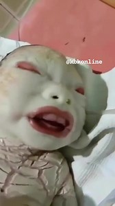 Harlequin ichthyosis is a severe genetic disorder that affects the skin. Infants with this condition are born prematurely with very hard, thick skin covering most of their bodies. The skin forms large, diamond-shaped plates that are separated by deep cracks (fissures). #kbkfoundation | Kbkonline