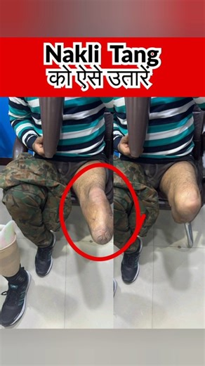 Bornlife Artificial Limbs Centre on Instagram: "Donning and doffing an artificial leg are two essential steps every prosthetic user must learn. Donning means correctly wearing the prosthetic leg so that the socket fits comfortably and safely. Doffing means removing the artificial leg without causing friction, pain, or skin irritation. Proper donning and doffing improve comfort, stability, mobility, and protect the stump from pressure marks. With regular practice and correct technique, users expe