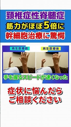 「魔法にかかったみたい！」頚椎症性脊髄症の方が再生医療を受けて筋力が５倍に!