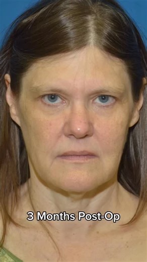 Our beautiful patient is now 3 months post face & neck lift with neck liposuction. Her healing process has been amazing, and her definition and contour continue to improve beautifully each week. She’s absolutely thrilled with her natural, refreshed look and we couldn’t be happier for her. 🤍 #doubleboardcertified #beforeandafterresults #faceliftsurgery #neckliftsurgery #neckliposuction #facialrejuvenation #jawlinedefinition #antiagingsolution #postop #plasticsurgeryclinic #bellevueplasticsurgery