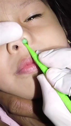 Whoah! #nasalforeignbody #nasalforeignobject #foreignbodystuckinnose #fyp