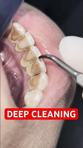 Professional Deep Cleaning of Heavy Tartar Build-Up