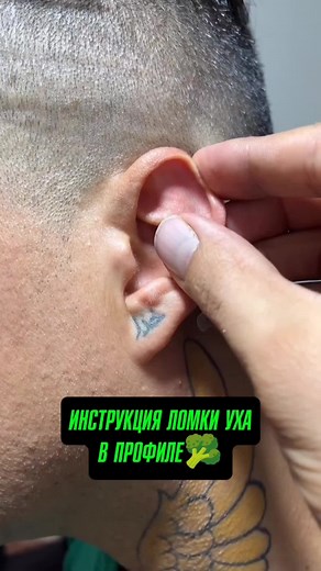 How to Treat Cauliflower Ear Effectively