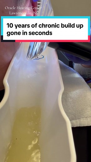 Aand that’s a wrap. 10 years of chronic wax build up gone in seconds. Suffice to day he was relieved 😅 Like and follow for more ear shenanigans. www.oraclehearingcenter.com #oraclehearingcenter #lawrencevillenj #earwaxremoval #earwaxextraction #earigator #hearingloss #audiologist #earwax #oraclehearingcenter #lawrencevillenj #drpimplepopper #satisfyingvideos #satisfying