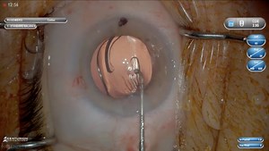 3D Visualization of Combination PanOptix IOL and iStent Implantation - Eyetube