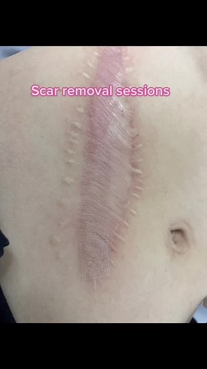 Fractional CO2 Laser for Scar Removal