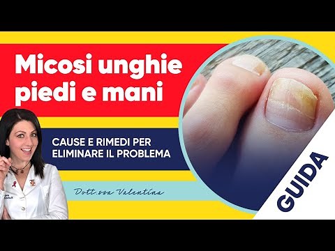 Micosi unghie piedi e mani: le cause e i rimedi per eliminare il problema