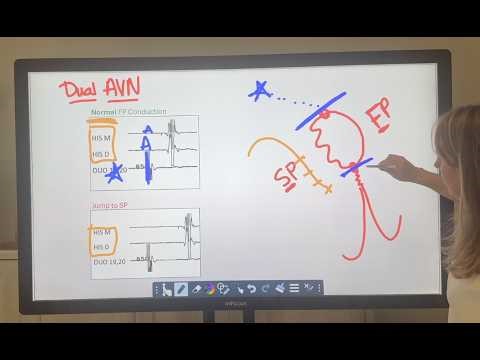 Dual AV Nodal Physiology