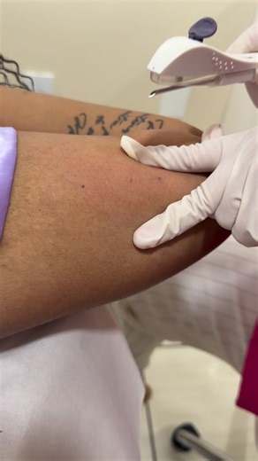 Consultório HumanNurse • Enfermagem Saúde da Mulher on Instagram: "O MOMENTO QUE MUDA ROTINAS E VIDA! Mais uma mulher escolheu viver leve, livre e sem preocupações com a inserção do Implanon aqui no HumanNurse. ✔️ Procedimento rápido, praticamente indolor e realizado com todo o cuidado da Dra. Júlia referência em inserção de Implanon e atendimento verdadeiramente humanizado. Imagina só: até 3 anos sem se preocupar com anticoncepcional, sem alarmes no celular, sem esquecimentos… apenas liberdade,