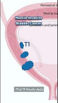 Video 135: Bladder Cancer – Types & Stages