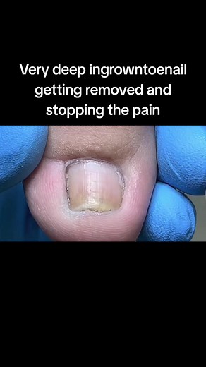 Ingrown Toenail Removal: Pain Relief Explained