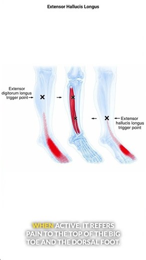 Extensor Hallucis Longus Trigger Points
