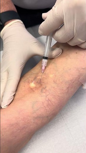 Besenreiser entfernen: Schaum-Sklerotherapie