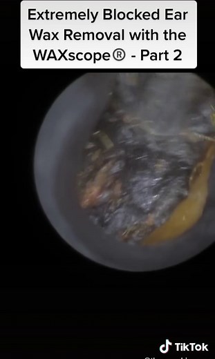 #earwax #ear #earcleaning #ears #earwaxremmoval #earwaxremoval #earwaxremnoval #earwaxing #earwaxcleaning #earwaxexpert #earwaxcamera #earwaxspecialist