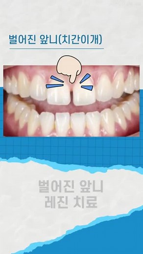 벌어진 앞니 레진 치료 방법