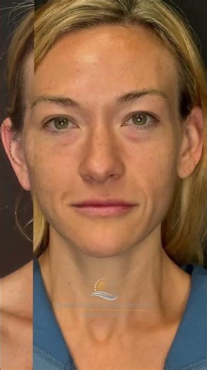 Mini facelift + cheek implants = ✨natural sculpt✨