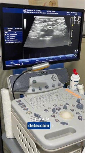 👩‍⚕️El Ultrasonido Doppler Venoso es un estudio no invasivo que permite evaluar el flujo sanguíneo en las venas, ayudando a detectar afecciones como varices, trombosis venosa profunda (TVP) y otras enfermedades circulatorias. • Este examen es clave para diagnosticar problemas venosos de manera temprana y prevenir complicaciones graves. ⚛ Clínica Altamira 📲 Citas al 7670 9031 🏥 Dirección (Managua): Bosques de Altamira, Farmavalue de la calle principal 3c arriba, #328. #clinicaaltamira #ultraso